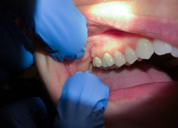 Best Emergency Dental Care for Broken or Chipped Teeth in Lake Wazeecha, WI