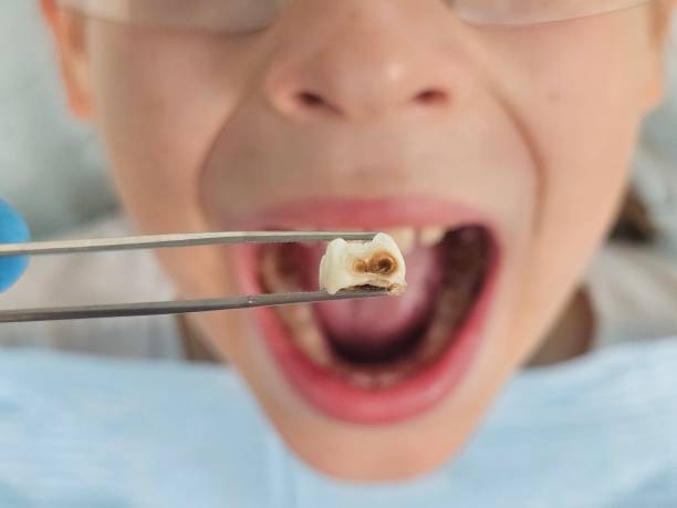 Best Emergency Dental Care for Broken or Chipped Teeth in Lake Wazeecha, WI